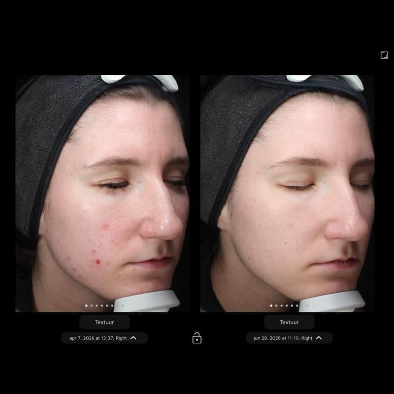 NIEUWS 1001 Pluryal Mesoline Clear & Exoyouth 02